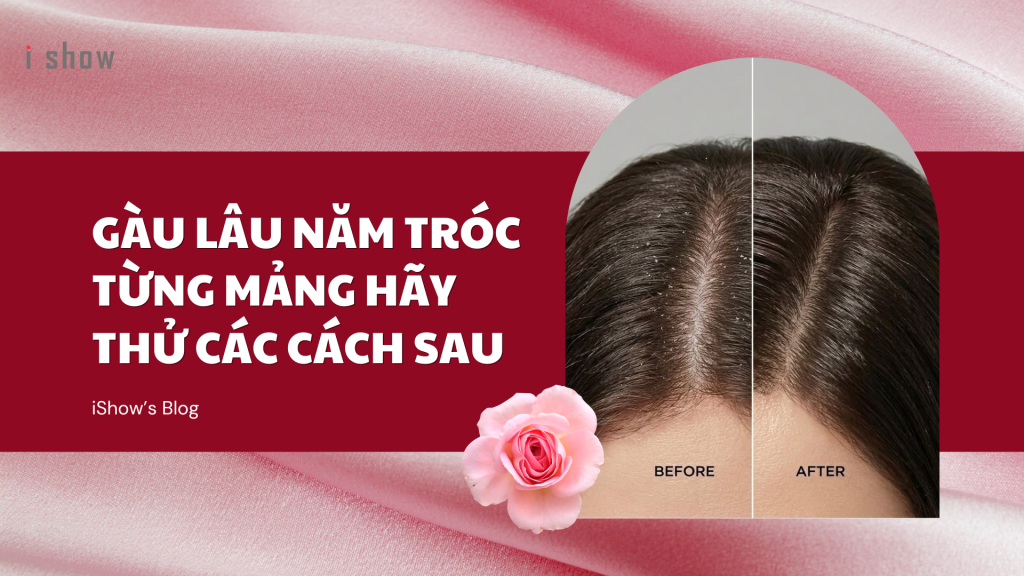 gàu gàu ngứa cách trị gàu gàu li ti gàu mảng ngứa da đầu trị gàu hết ngứa da đầu công thức trị gàu tại nhà trị gàu đơn giản